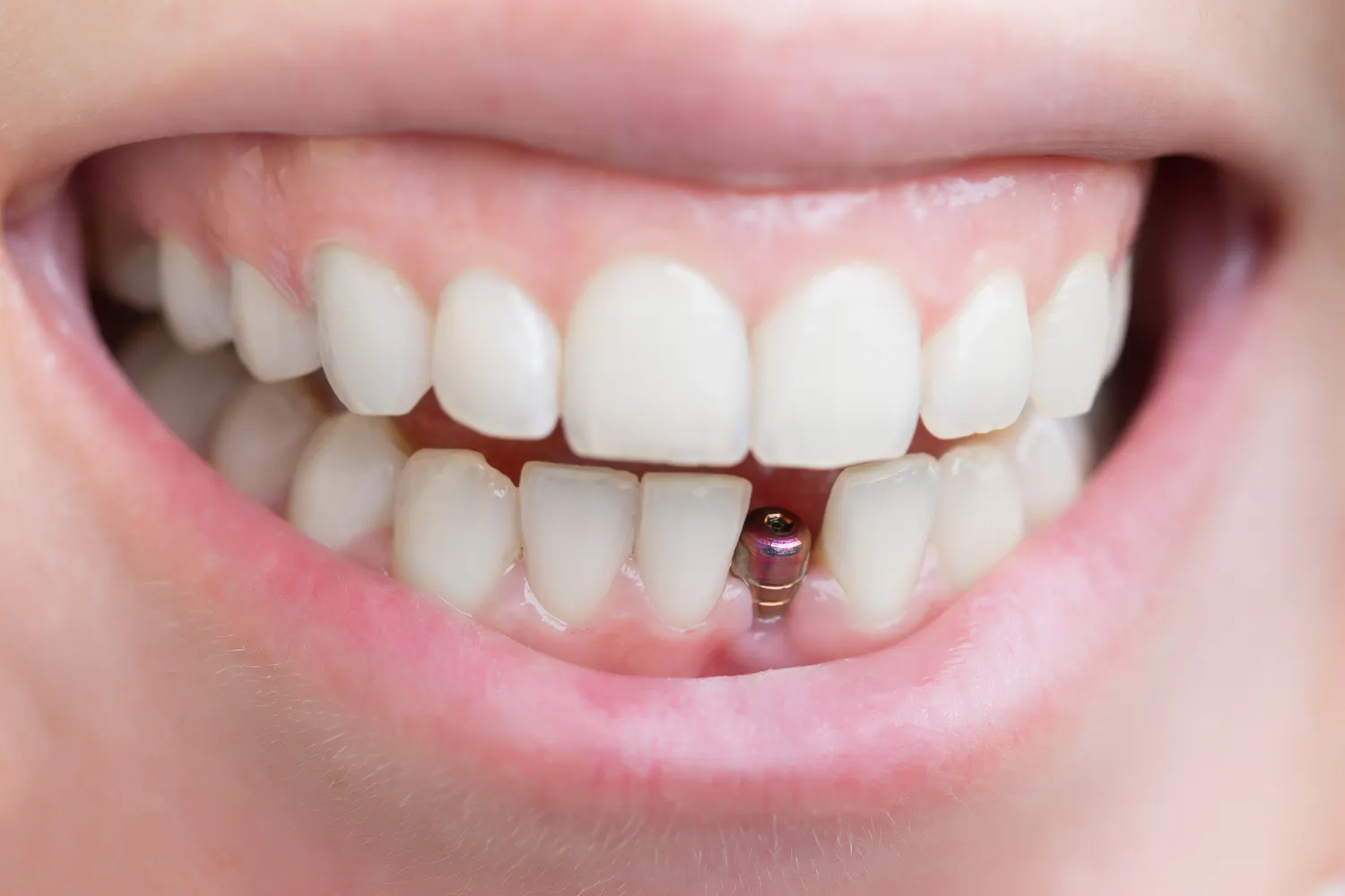 Rodzaje implantów zębowych